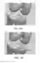 Fig. 76 - Apparatus and method for ligament reconstruction