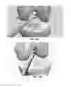 Fig. 86 - Apparatus and method for ligament reconstruction