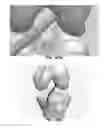 Fig. 87 - Apparatus and method for ligament reconstruction