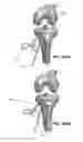 Fig. 97 - Apparatus and method for ligament reconstruction