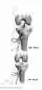 Fig. 98 - Apparatus and method for ligament reconstruction