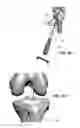 Fig. 99 - Apparatus and method for ligament reconstruction