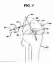 Fig. 05 - Methods for ligament reconstruction