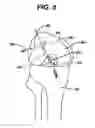 Fig. 06 - Methods for ligament reconstruction