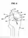 Fig. 07 - Methods for ligament reconstruction