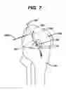 Fig. 08 - Methods for ligament reconstruction