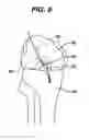 Fig. 09 - Methods for ligament reconstruction