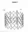 Fig. 07 - Method and apparatus for fine adjustment of a percutaneous valve structure