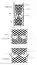 Fig. 43 - Transcatheter Mitral Valve Replacement Apparatus