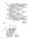 Fig. 02 - Leaflet-cuff attachments for prosthetic heart valve