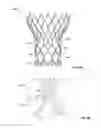 Fig. 08 - Leaflet-cuff attachments for prosthetic heart valve