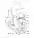 Fig. 07 - PROSTHETIC INSERT FOR TREATING A MITRAL VALVE
