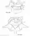 Fig. 08 - In-situ formed intervertebral fusion device and method