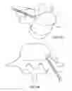 Fig. 09 - In-situ formed intervertebral fusion device and method