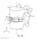Fig. 02 - Expandable intervertebral implant