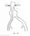 Fig. 24 - Fenestrated prosthesis