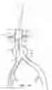 Fig. 45 - Fenestrated prosthesis