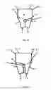 Fig. 04 - Men's briefs with separate space for penis comprising absorbent receptacle