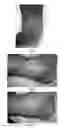 Fig. 04 - USE OF PHARMACEUTICAL COMPOSITIONS IN PREPARING PHARMACEUTICALS FOR TREATING DIABETIC ULCER