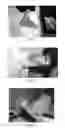 Fig. 06 - USE OF PHARMACEUTICAL COMPOSITIONS IN PREPARING PHARMACEUTICALS FOR TREATING DIABETIC ULCER