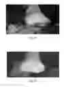 Fig. 09 - USE OF PHARMACEUTICAL COMPOSITIONS IN PREPARING PHARMACEUTICALS FOR TREATING DIABETIC ULCER
