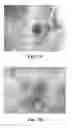 Fig. 11 - Collagen scaffolds, medical implants with same and methods of use