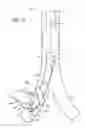 Fig. 09 - MULTI-LUMEN TRACHEAL TUBE WITH VISUALIZATION DEVICE