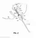 Fig. 03 - Cuff-resistant anchoring balloon for medical device