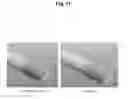 Fig. 12 - Device for protecting the rectal anastomosis