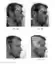 Fig. 02 - Transdermal electrical stimulation devices for modifying or inducing cognitive state