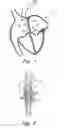 Fig. 02 - Septal closure device with centering mechanism