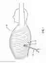 Fig. 02 - Devices and methods for heart valve repair