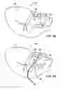 Fig. 08 - Devices and methods for heart valve repair