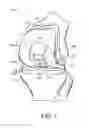 Fig. 02 - Systems and methods for preparing a proximal tibia