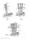 Fig. 08 - Derotation apparatus for treating spinal irregularities