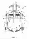 Fig. 02 - Spinal stabilization system