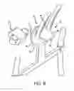 Fig. 09 - Spinal stabilization system