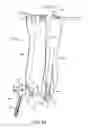 Fig. 45 - Spinal stabilization system