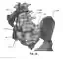 Fig. 131 - Systems and methods for fusing a sacroiliac joint and anchoring an orthopedic appliance