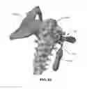 Fig. 136 - Systems and methods for fusing a sacroiliac joint and anchoring an orthopedic appliance
