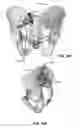 Fig. 158 - Systems and methods for fusing a sacroiliac joint and anchoring an orthopedic appliance