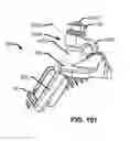 Fig. 201 - Systems and methods for fusing a sacroiliac joint and anchoring an orthopedic appliance