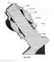 Fig. 239 - Systems and methods for fusing a sacroiliac joint and anchoring an orthopedic appliance