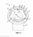 Fig. 35 - Systems and methods for fusing a sacroiliac joint and anchoring an orthopedic appliance