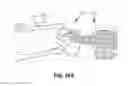 Fig. 65 - Systems and methods for fusing a sacroiliac joint and anchoring an orthopedic appliance