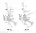 Fig. 72 - Systems and methods for fusing a sacroiliac joint and anchoring an orthopedic appliance