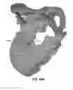 Fig. 80 - Systems and methods for fusing a sacroiliac joint and anchoring an orthopedic appliance