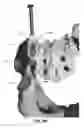Fig. 82 - Systems and methods for fusing a sacroiliac joint and anchoring an orthopedic appliance