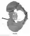 Fig. 83 - Systems and methods for fusing a sacroiliac joint and anchoring an orthopedic appliance