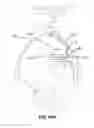 Fig. 85 - Systems and methods for fusing a sacroiliac joint and anchoring an orthopedic appliance